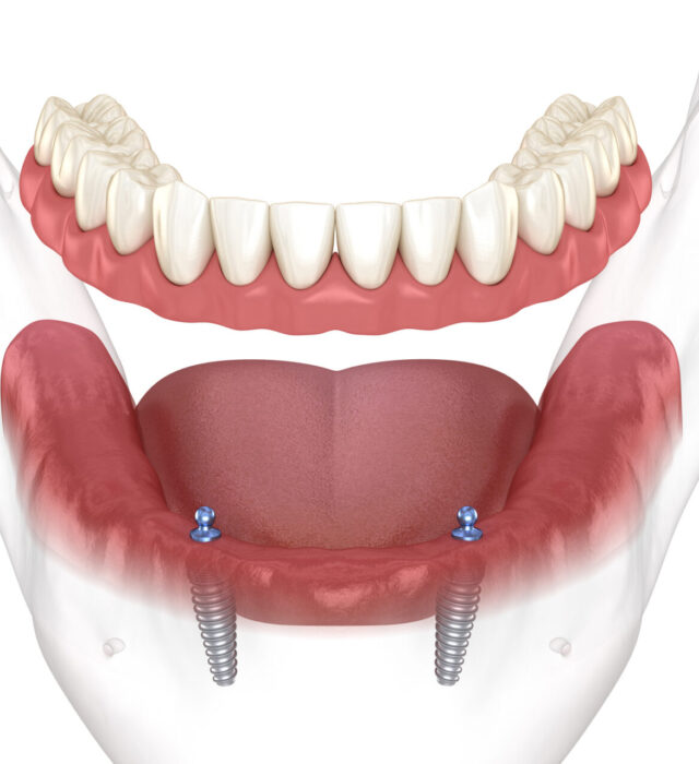 Implant Over-Dentures in Coffs Harbour